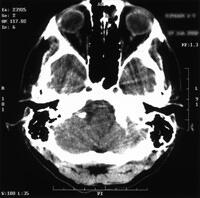 brain